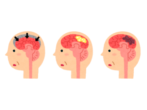 認知症の4つの種類と特徴について