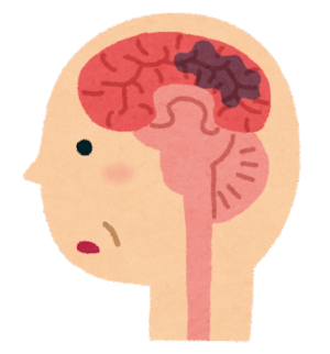 脳血管性認知症の特徴と予防について